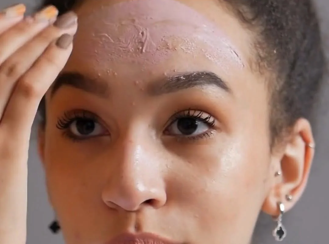 5 Critical Acne Warning Signs You Shouldn’t Ignore: When to Seek Professional Help